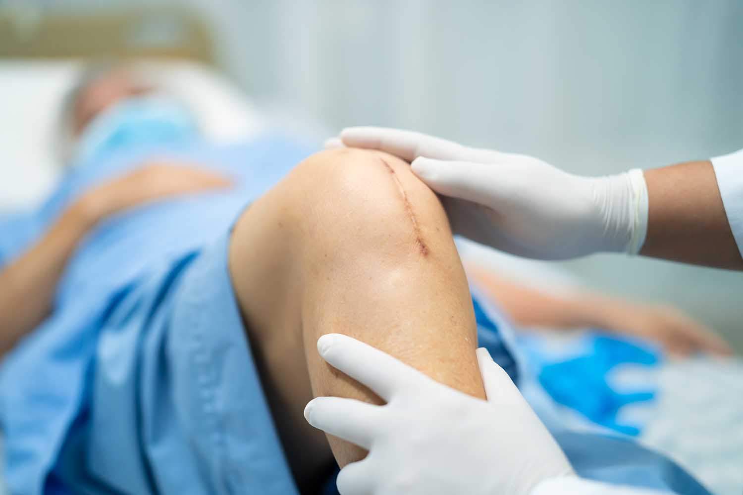 knee replacement surgery