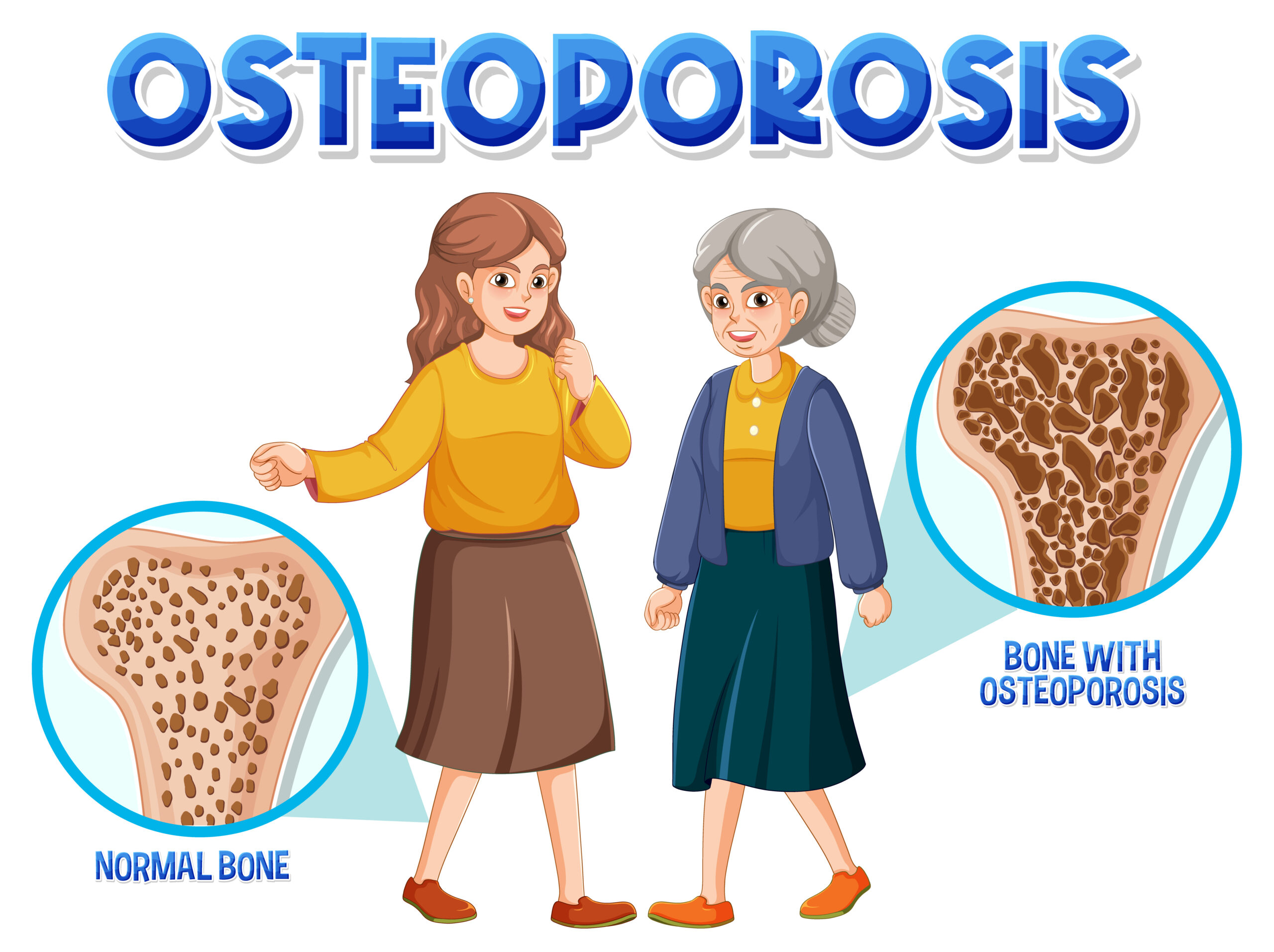 osteoporosis definition
