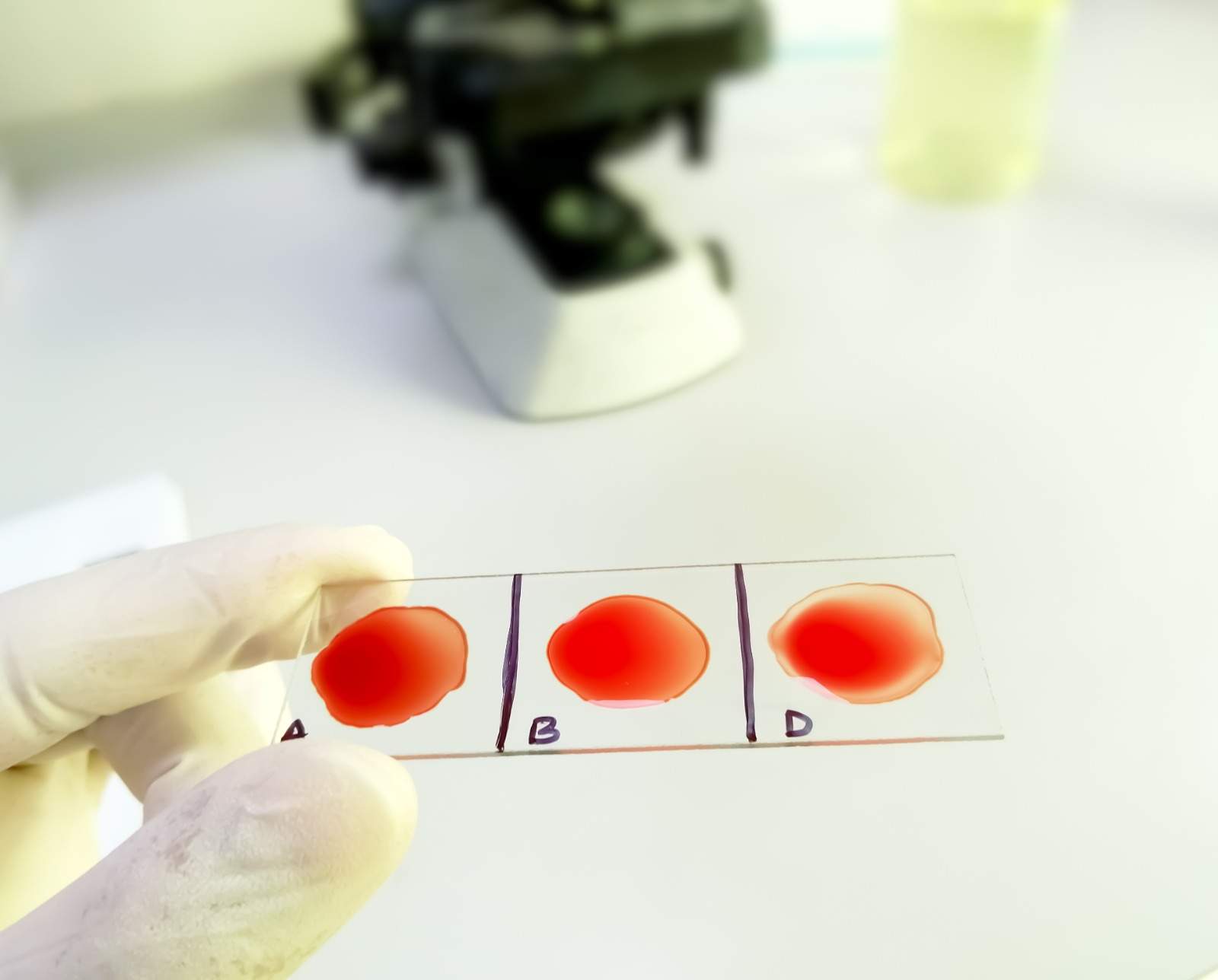 You are currently viewing Everything to Know About Erythrocyte Sedimentation Rate (ESR)