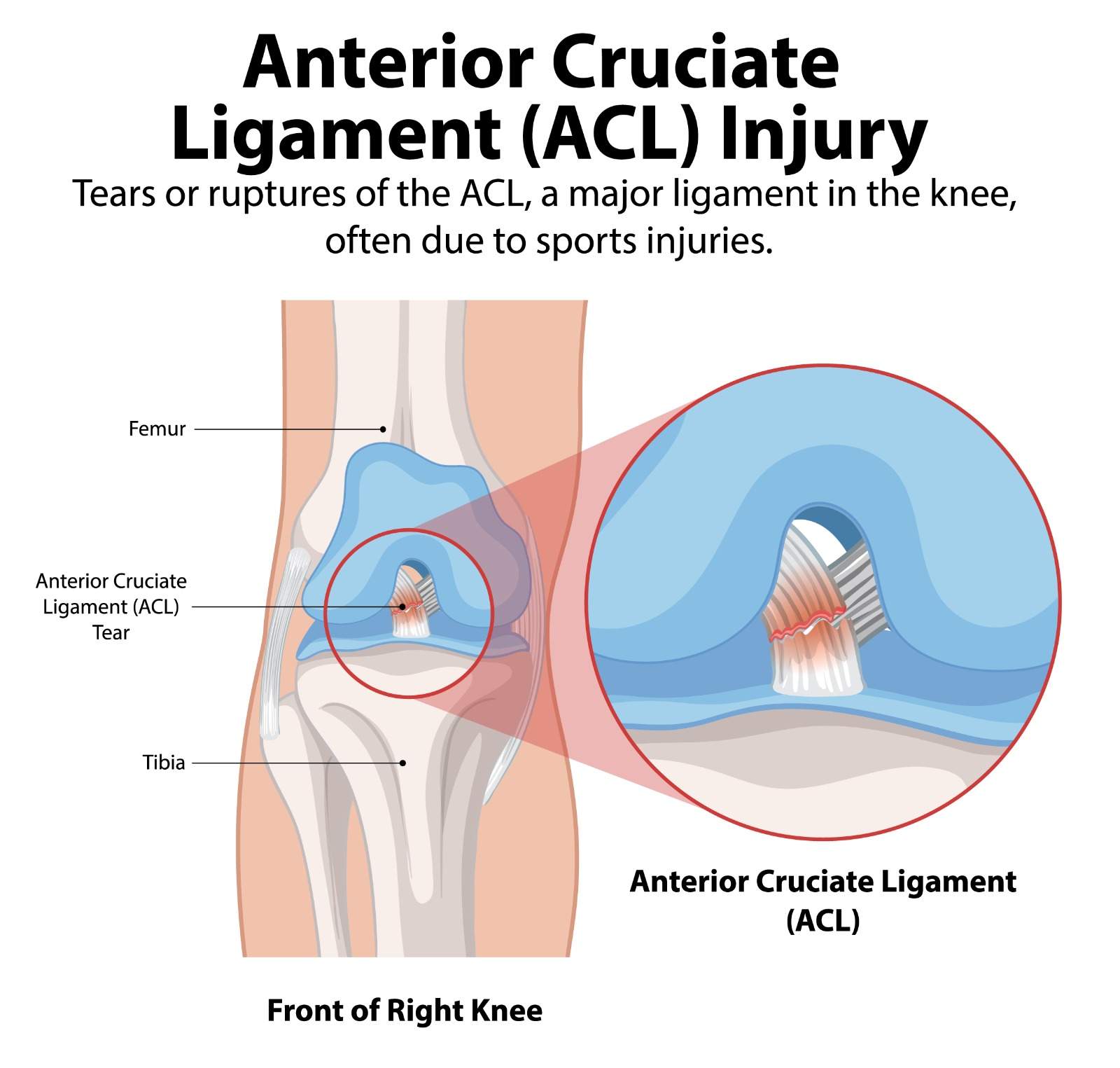 You are currently viewing ACL Reconstruction Surgery: What Is It and When Is It Needed?